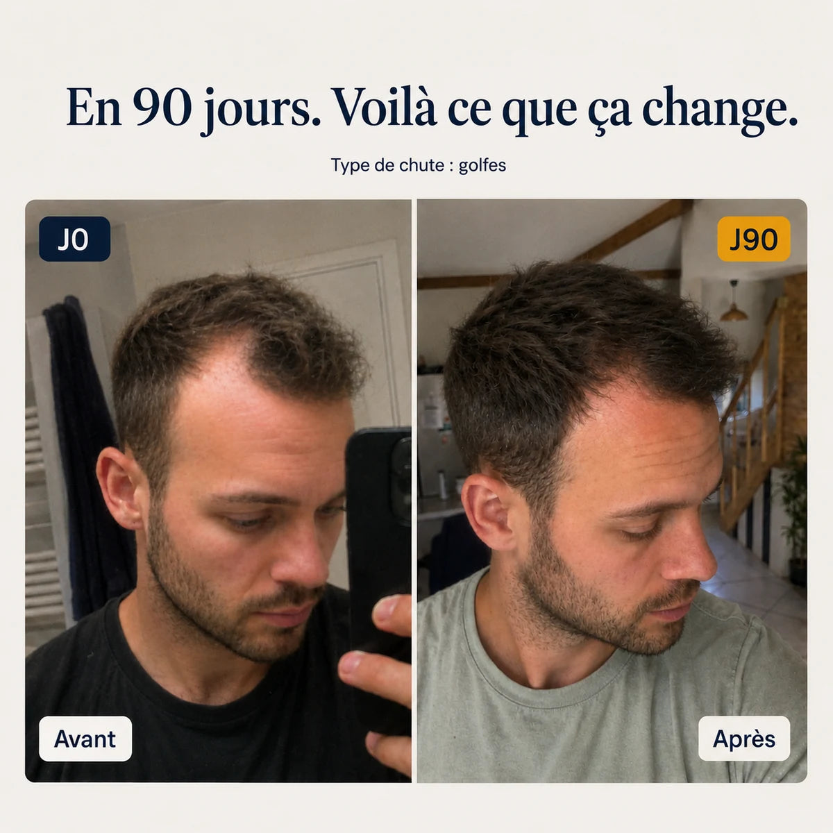 Avant/après en 90 jours sur les golfes avec le sérum anti-chute BREEZ