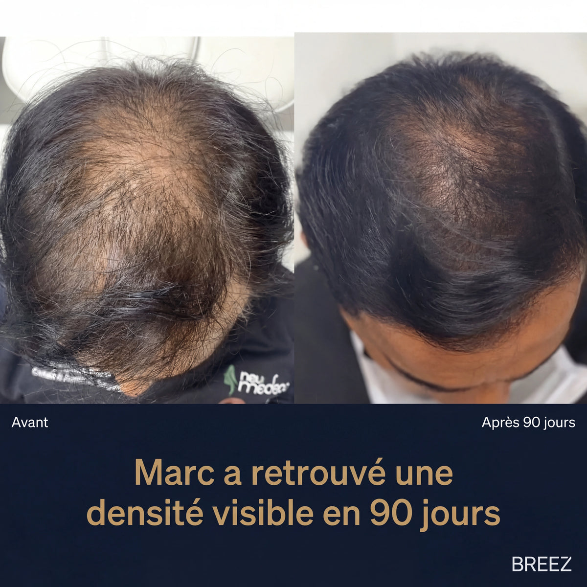 Texture légère du sérum anti-chute BREEZ pour cheveux homme