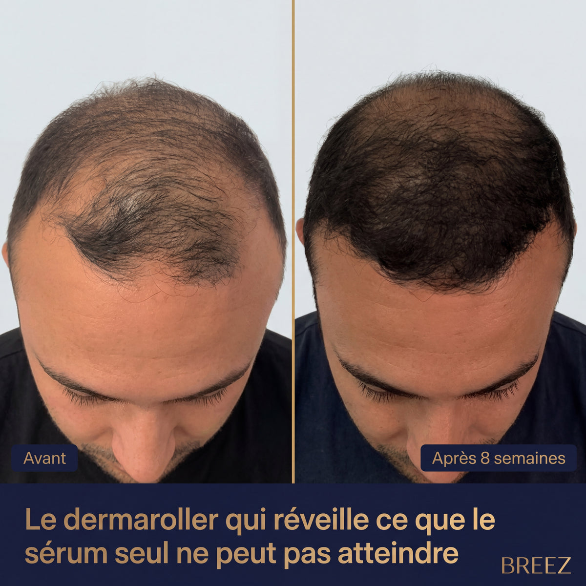 Étui de protection du dermaroller BREEZ — hygiène garantie