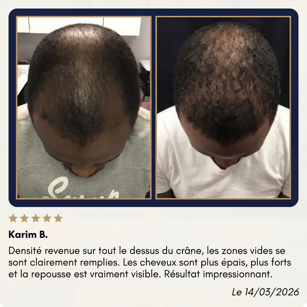 Utilisation du dermaroller BREEZ sur cuir chevelu homme