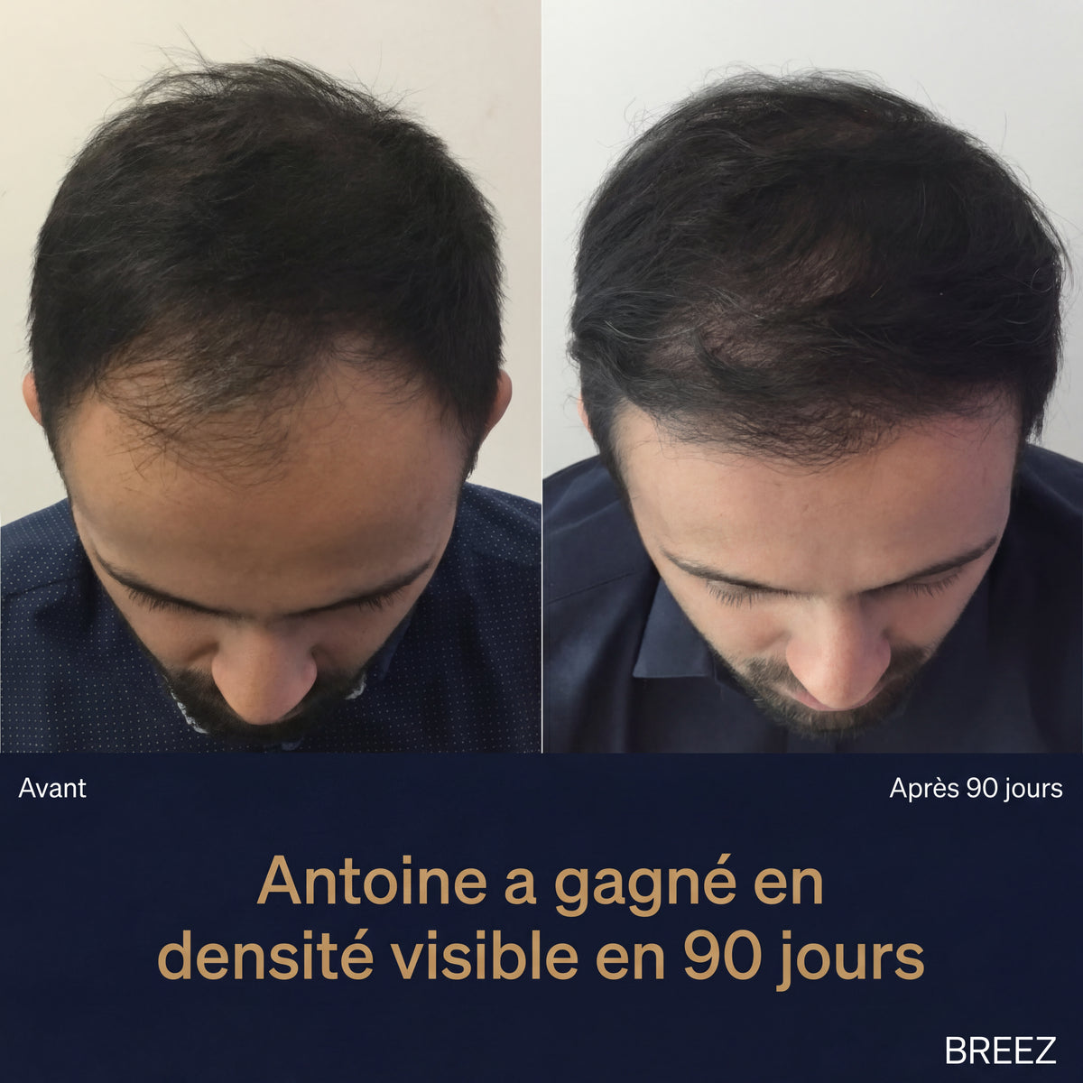 Brosse de massage cuir chevelu BREEZ