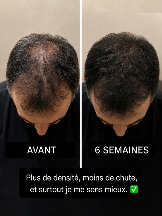 Avant / apres d'un client BREEZ : plus de densite et moins de chute apres 6 semaines.